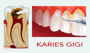 karies gigi