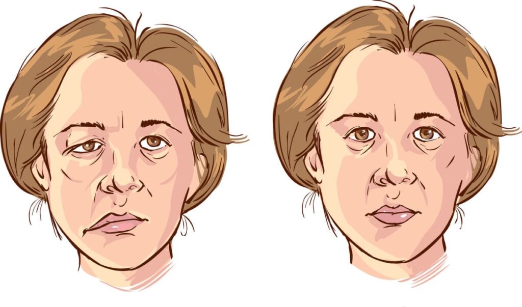 kenali bell's palsy