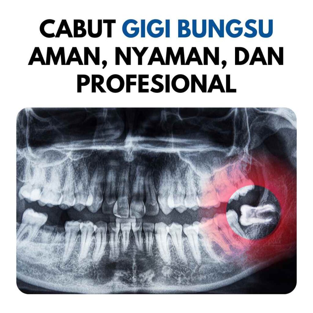 cabut gigi bungsu
