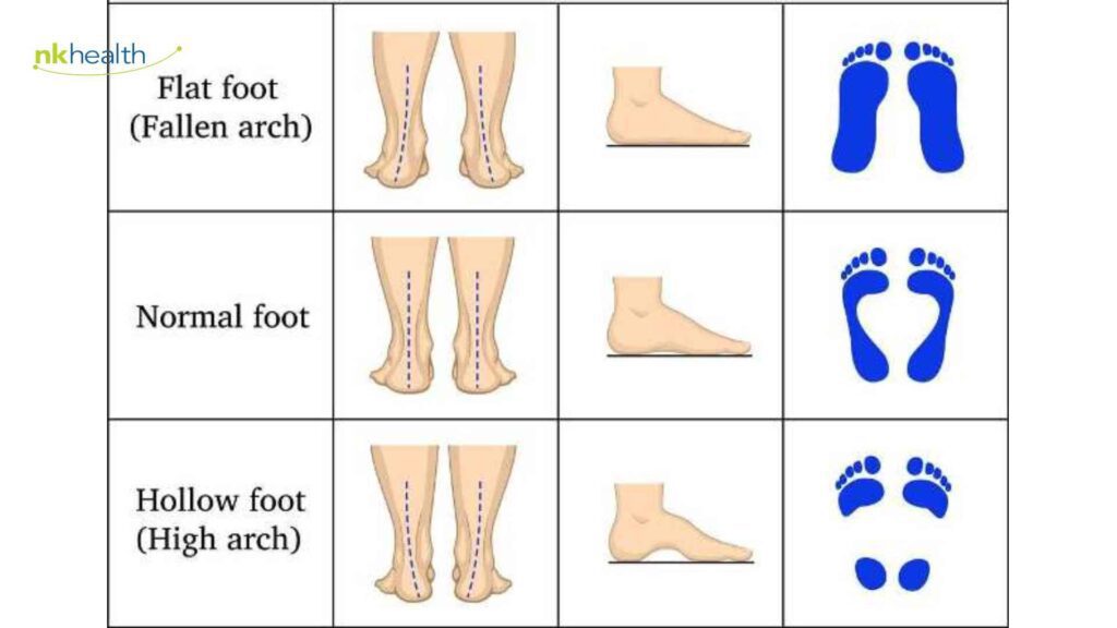 fisioterapi pada flat foot