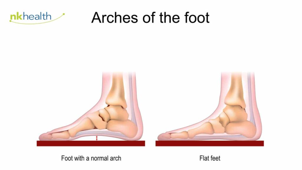 Fisioterapi pada flat foot