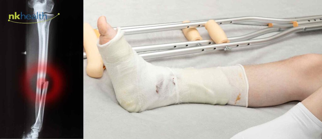 fisioterapi patah tulang kaki