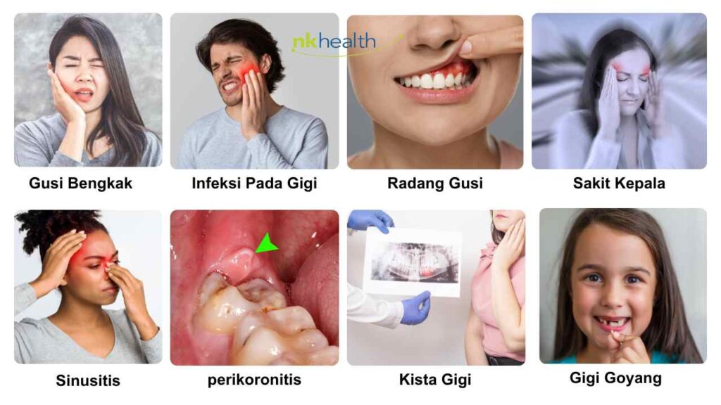 resiko gigi bungsu tidak dicabut