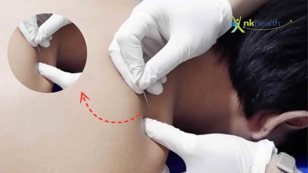 biaya terapi dry needling
