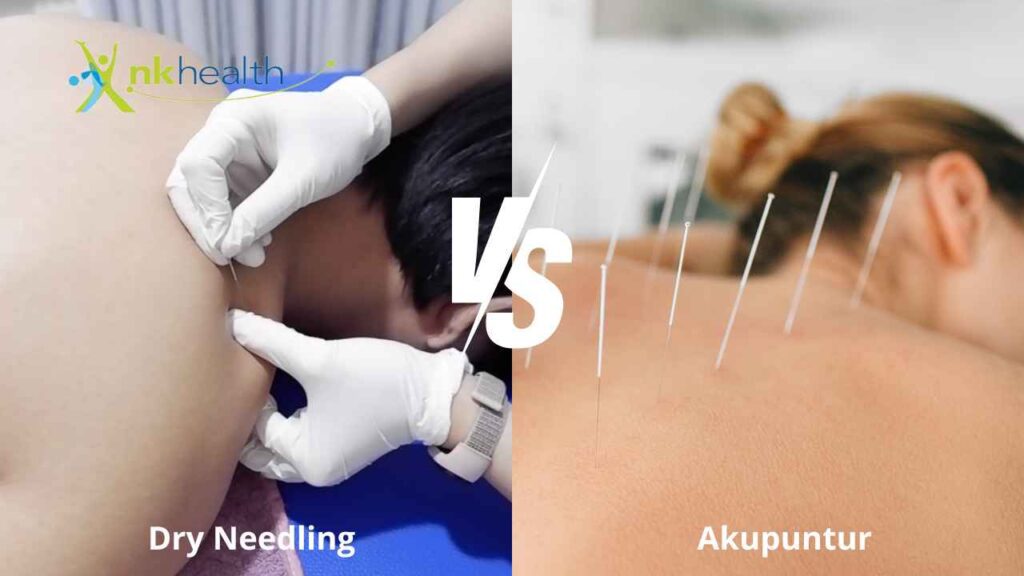 perbedaan dry needling dan akupuntur