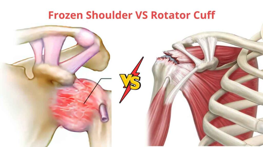 Perbedaan Frozen Shoulder dan Rotator Cuff