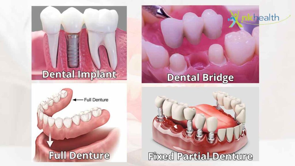 Jenis-Jenis Gigi Palsu Permanen