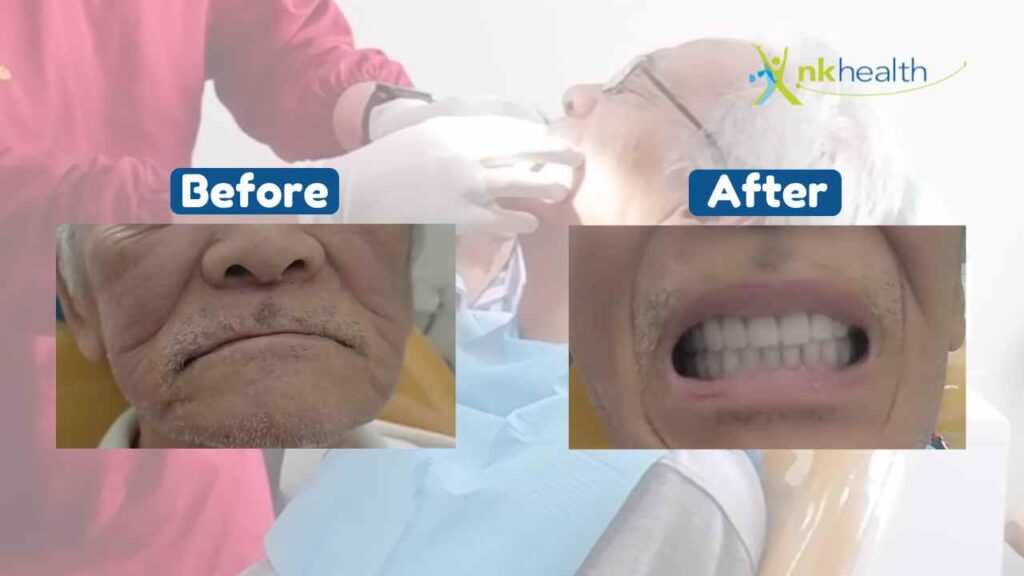 pasang gigi palsu