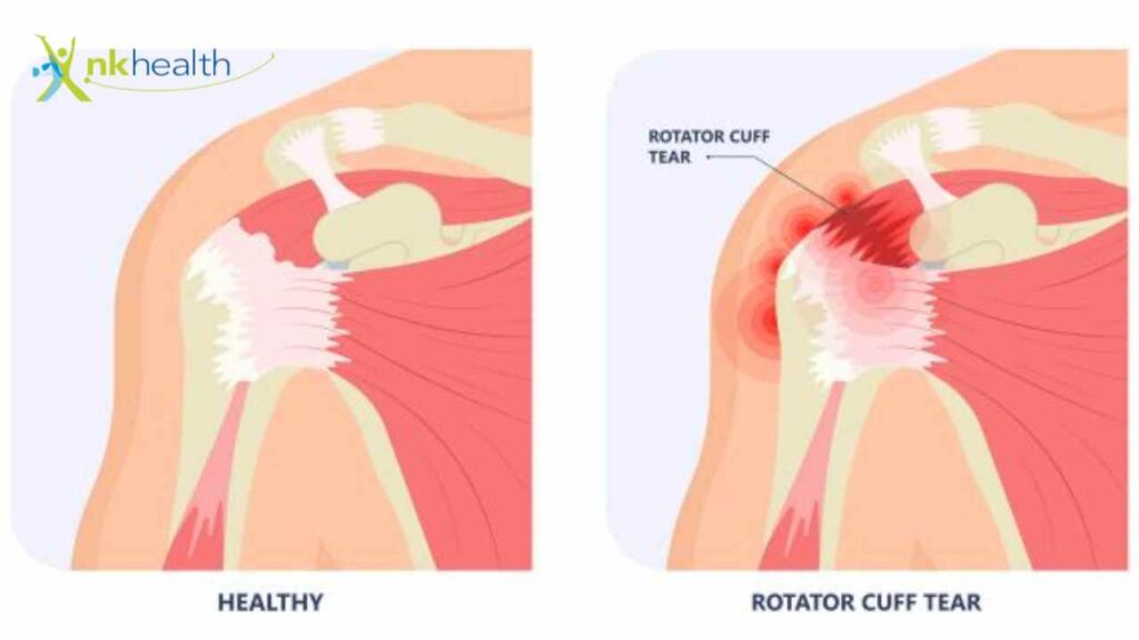 Cedera Bahu Rotator Cuff