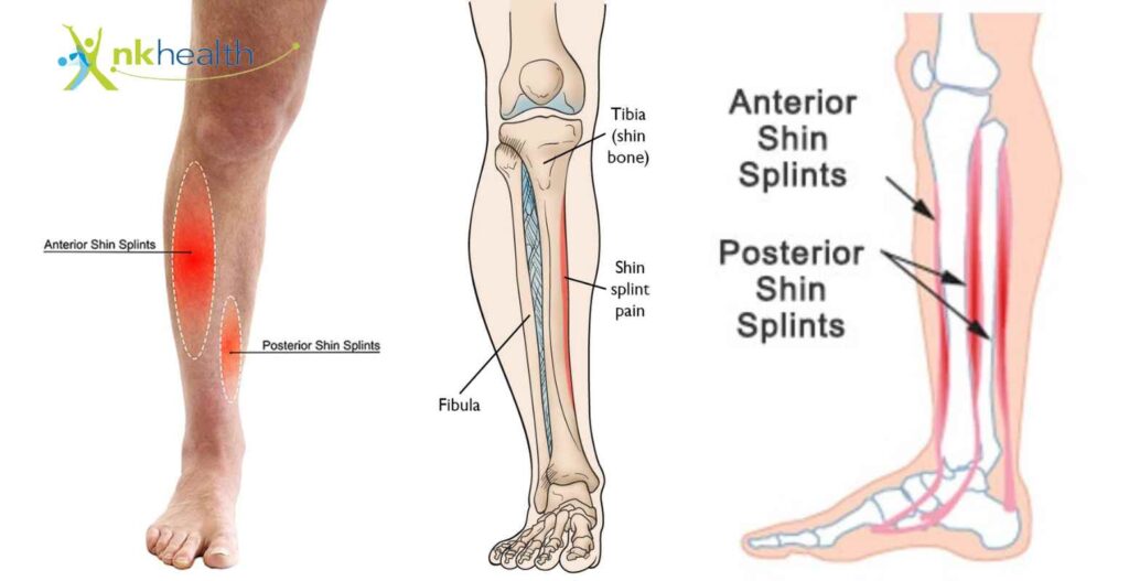Cedera Shin Splints