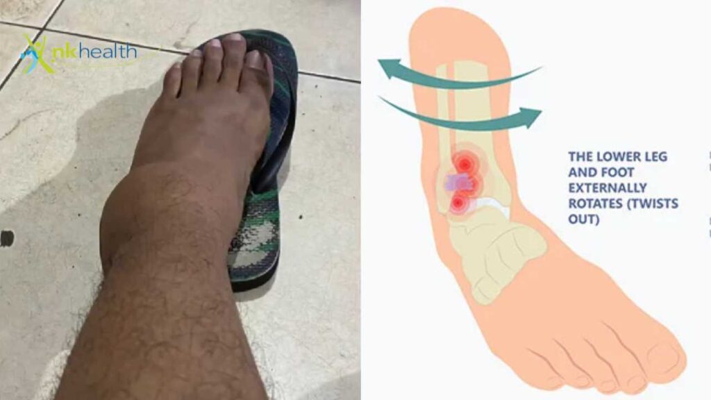 Apa yang Harus Dilakukan Jika Ankle Bengkak?
