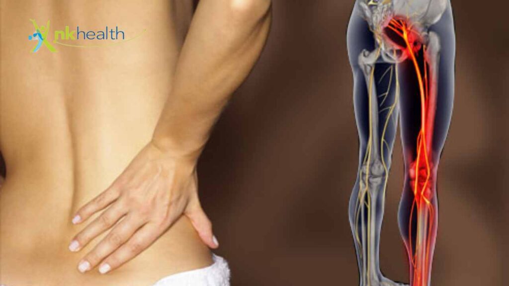 Fisioterapi menyembuhkan Saraf Sciatica