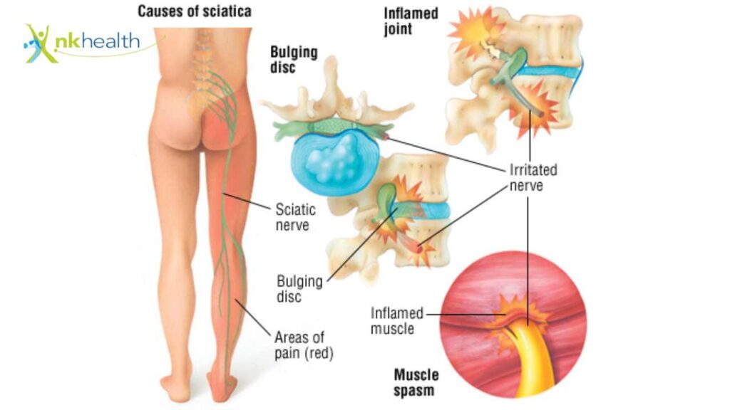 Nyeri Saraf Sciatica