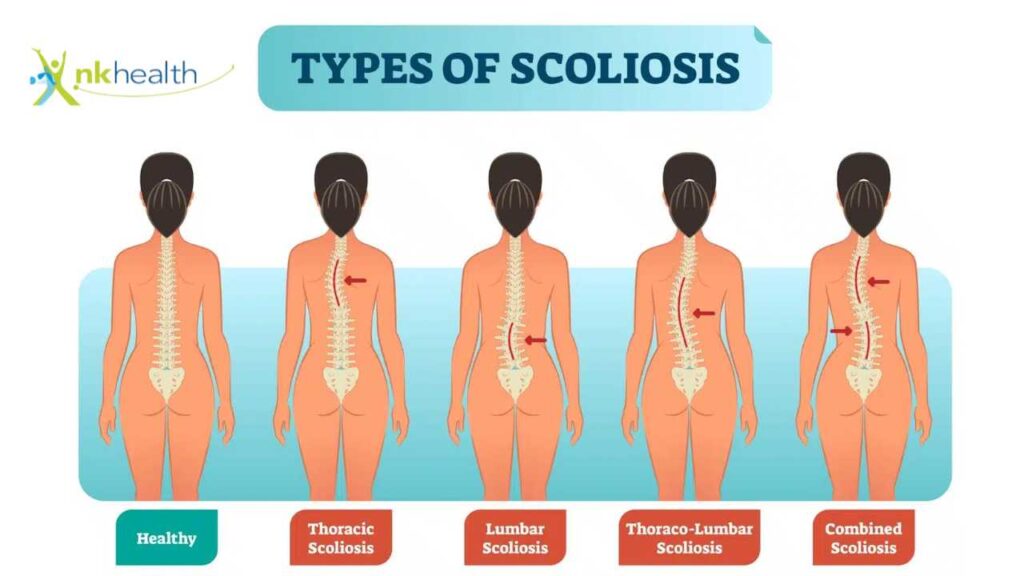 tipe skoliosis