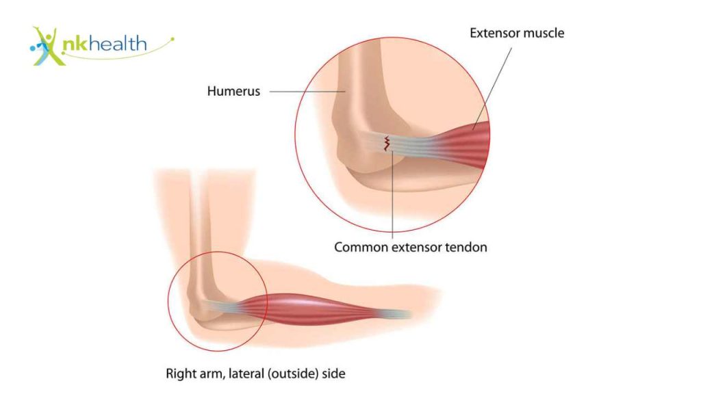 Penyebab Tennis Elbow