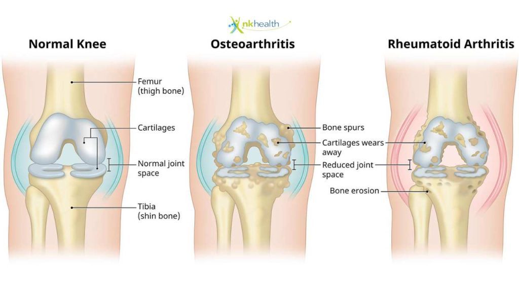 Gejala Osteoarthritis