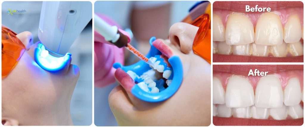 Bleaching Gigi Jakarta Terbaik