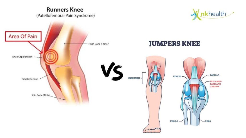Runner's Knee vs Jumper's Knee