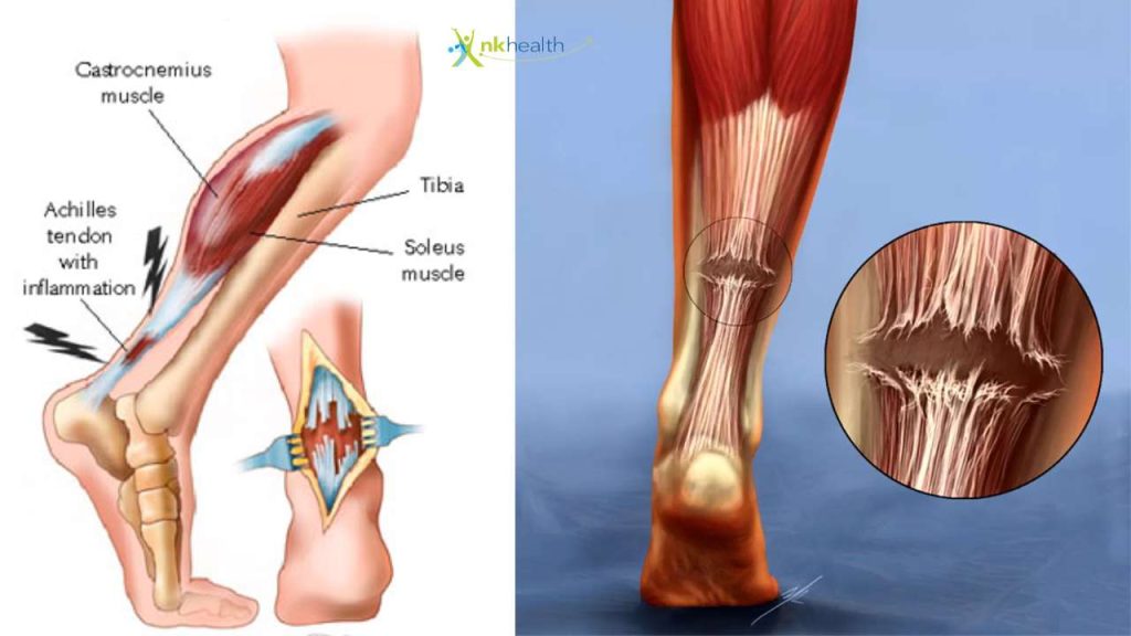Tendon Achilles Putus Apakah Bisa Sembuh