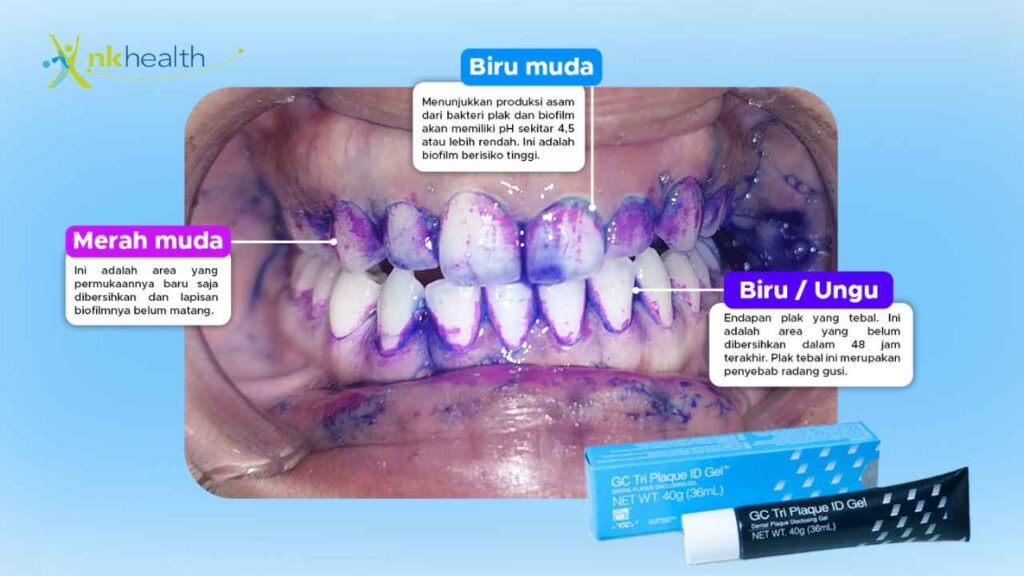 Tri Plaque Gel