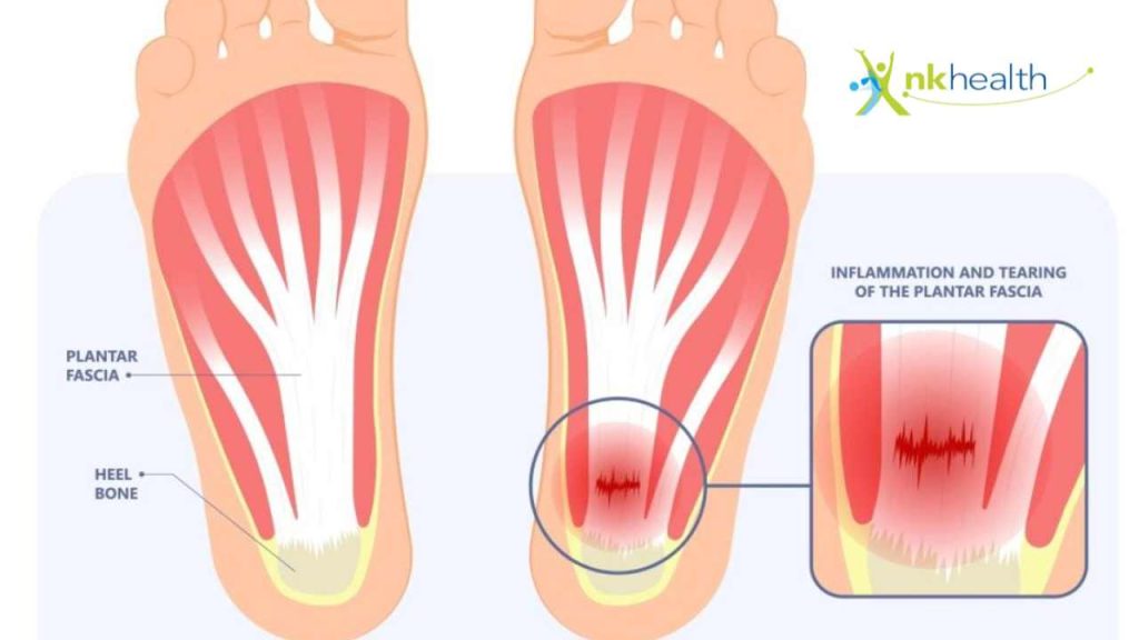 Gejala Plantar Fasciitis
