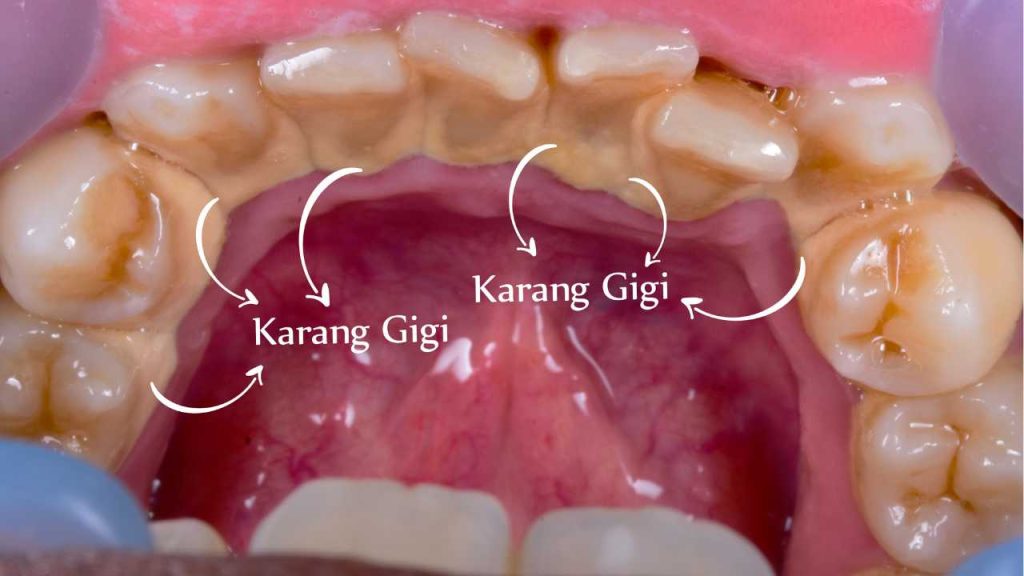 Karang Gigi