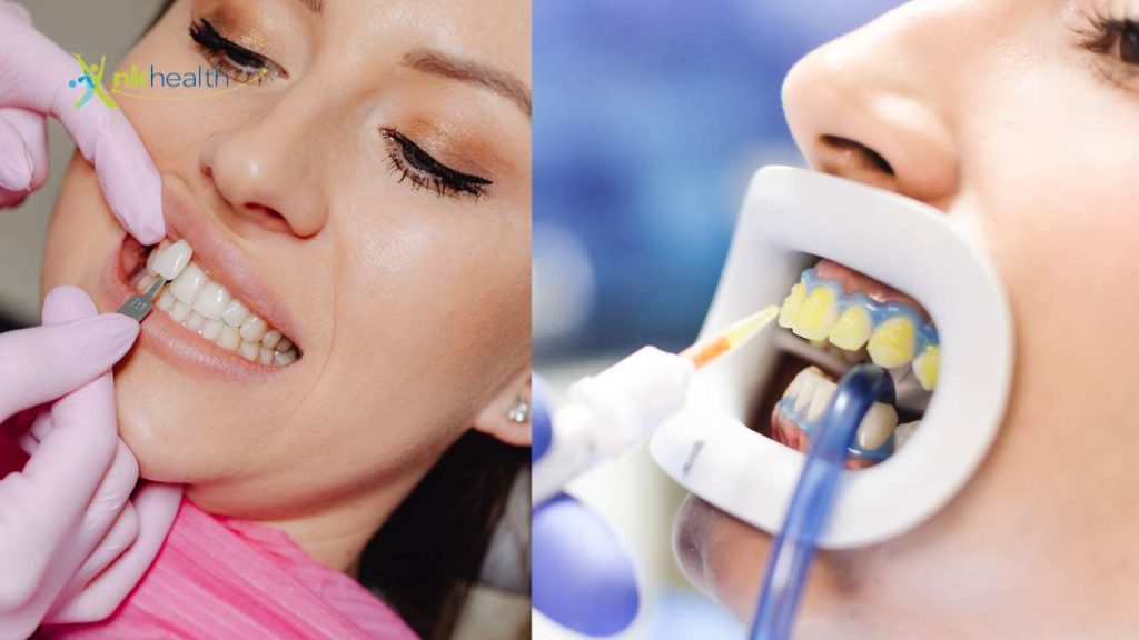 Perbedaan Veneer dan Bleaching Gigi