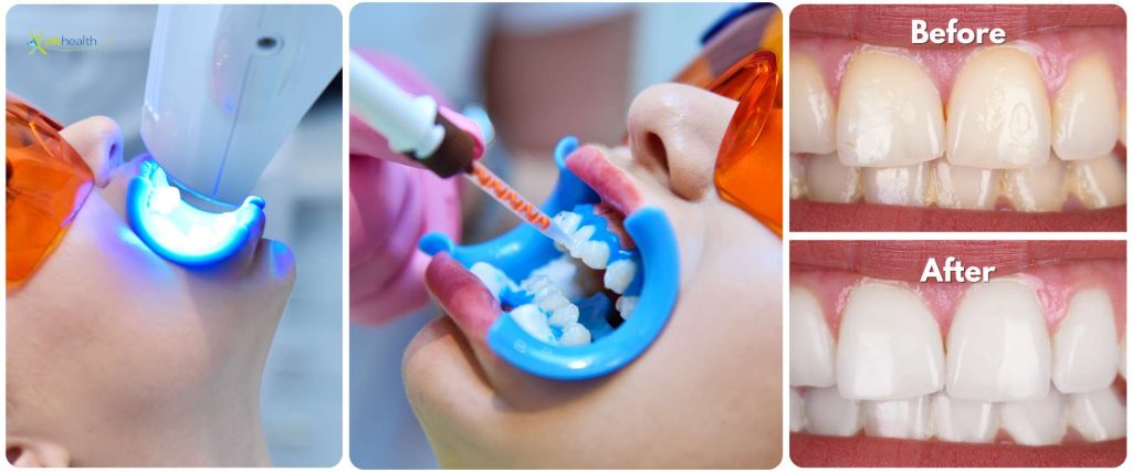 Bleaching Gigi Jakarta Terbaik