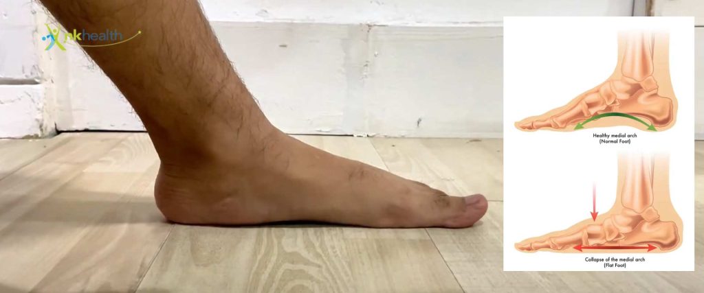 Flat foot atau kaki rata