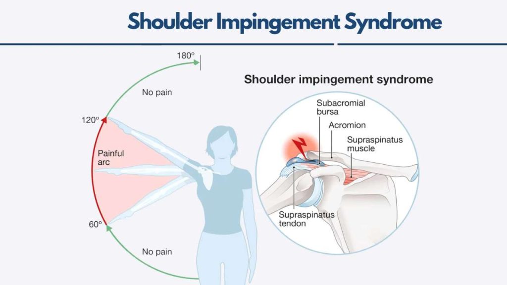 Shoulder Impingement