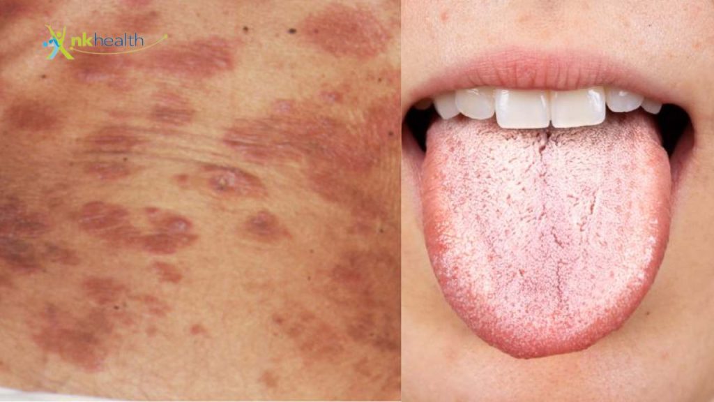 5 Ciri Ciri Orang Terinfeksi HIV