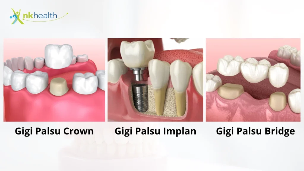 Jenis Gigi Palsu Permanen