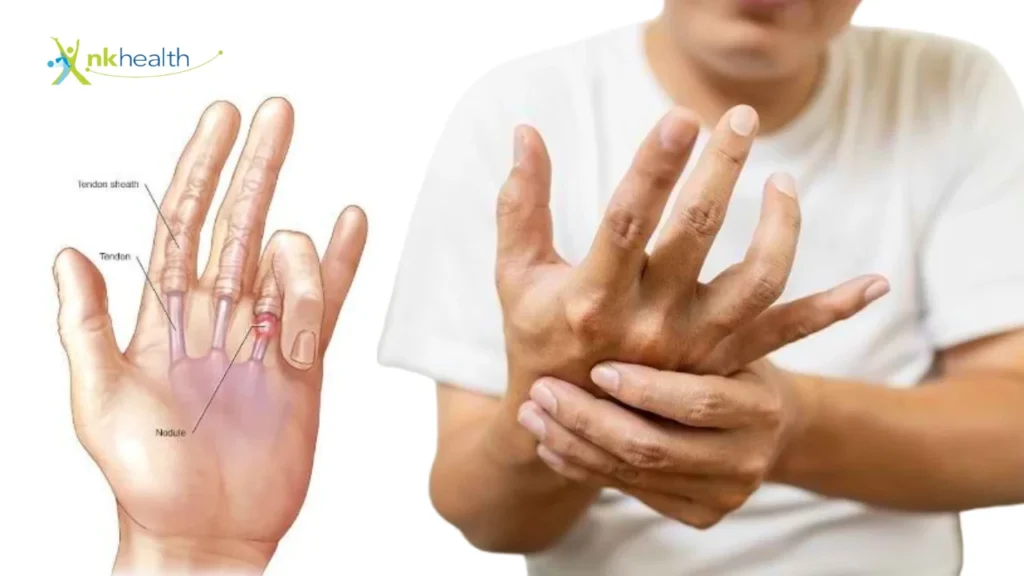 Cara Menyembuhkan Trigger Finger Secara Cepat