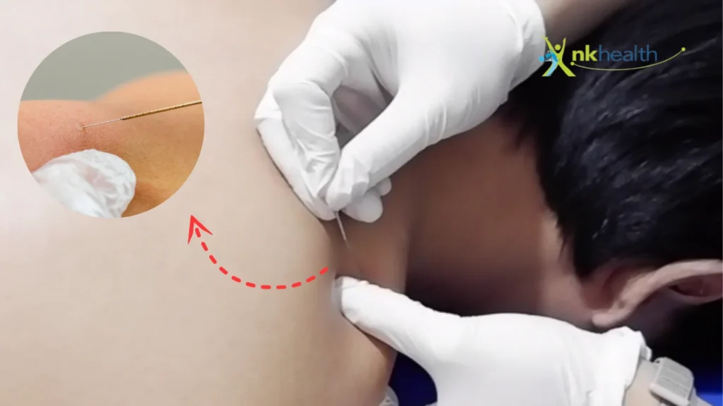 Dry Needling Bekasi Terbaik