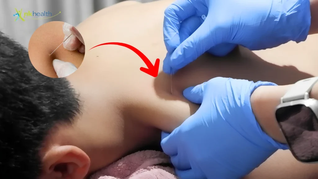 Dry Needling Fisioterapi, Menyembuhkan Nyeri Otot